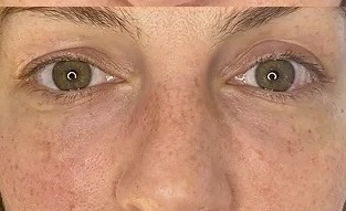 Патчі навколо очей Sesderma C-Vit Eye Contour Patches, 5 шт. Патчі навколо очей Sesderma C-Vit Eye Contour Patches, 5 шт.