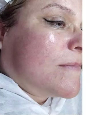 Зволожуючий гель проти розацеа Mediderma Anti-Redness Facial Gel 50 мл