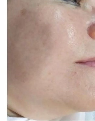 Зволожуючий гель проти розацеа Mediderma Anti-Redness Facial Gel 50 мл